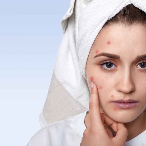 portrait-young-woman-having-problem-skin-pimple-her-cheek-wearing-towel-her-head-having-sad-expression-pointing_11zon