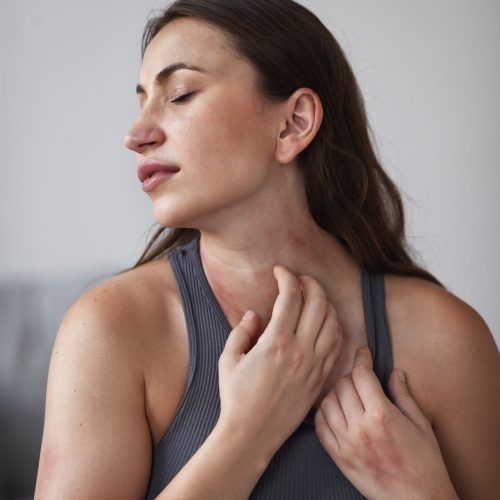 woman-suffering-from-rash