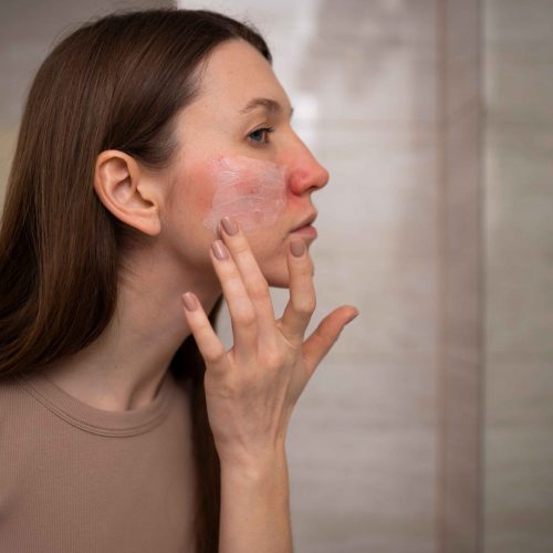 woman-using-moisturizer-help-with-rosacea-skin-condition_11zon